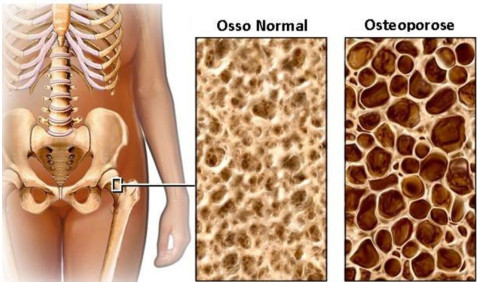 Osteoporose – Uma doença silenciosa